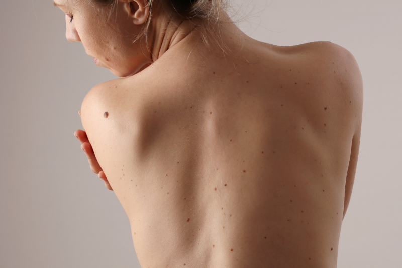Названы первые симптомы рака, заметные на коже